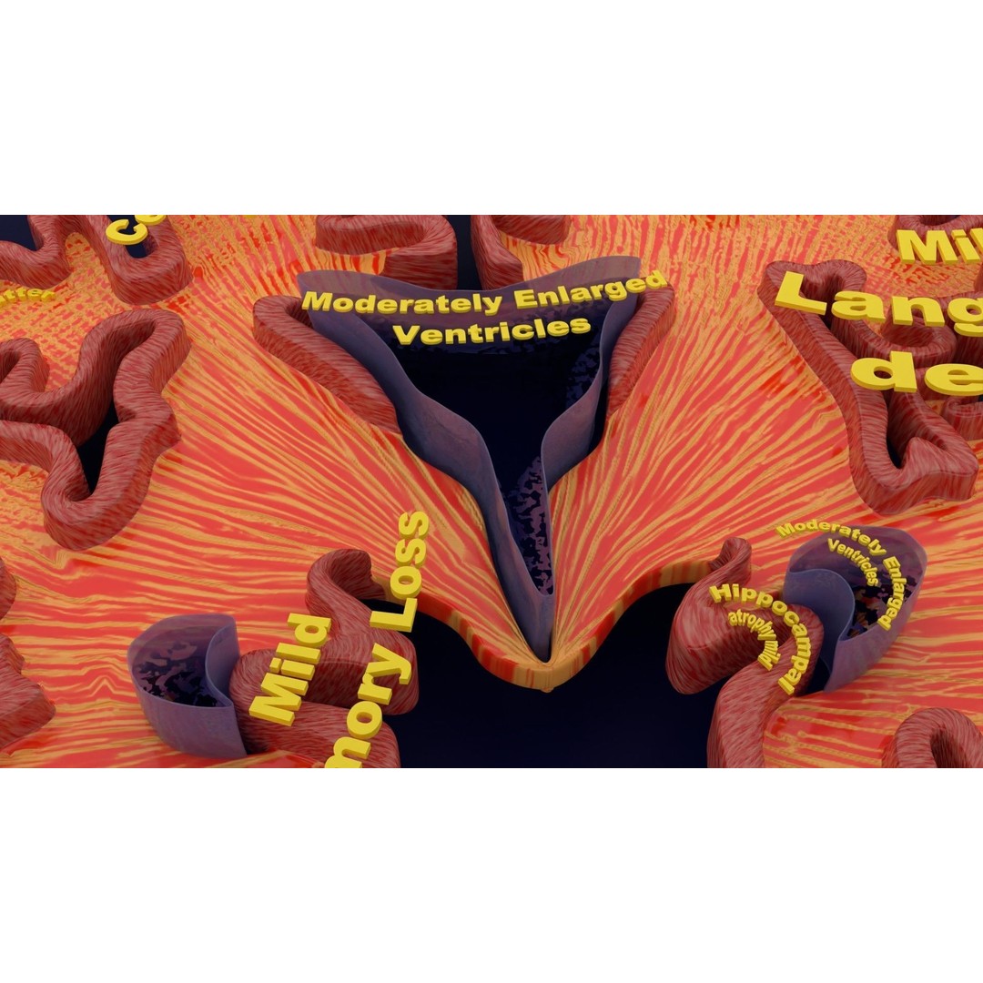 Alzheimer Disease Brain Coronal Slice 3D Model – PBR Textured, Multiple Formats - View 7