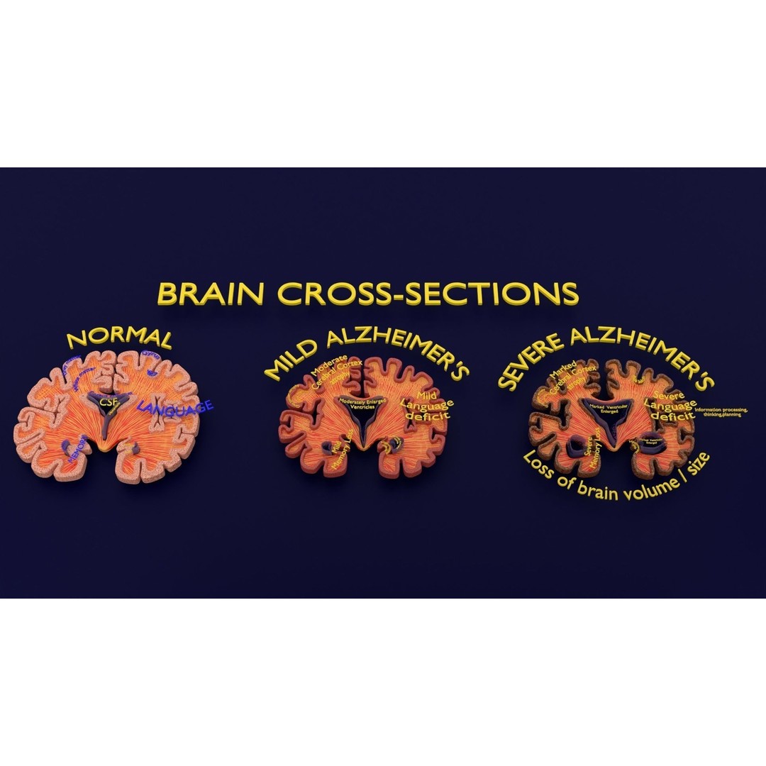 Alzheimer Disease Brain Coronal Slice 3D Model – PBR Textured, Multiple Formats - View 8