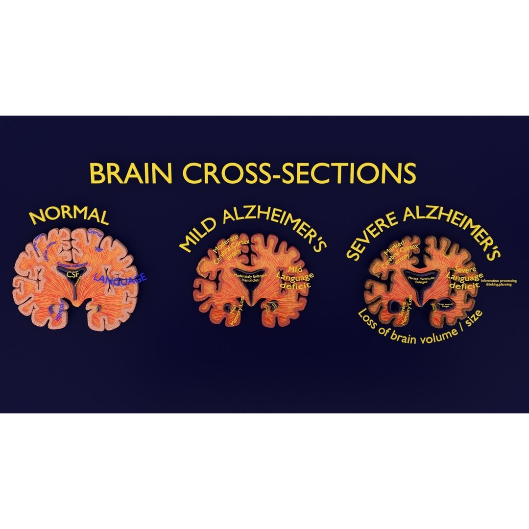 Alzheimer Disease Brain Coronal Slice 3D Model – PBR Textured, Multiple Formats - View 9