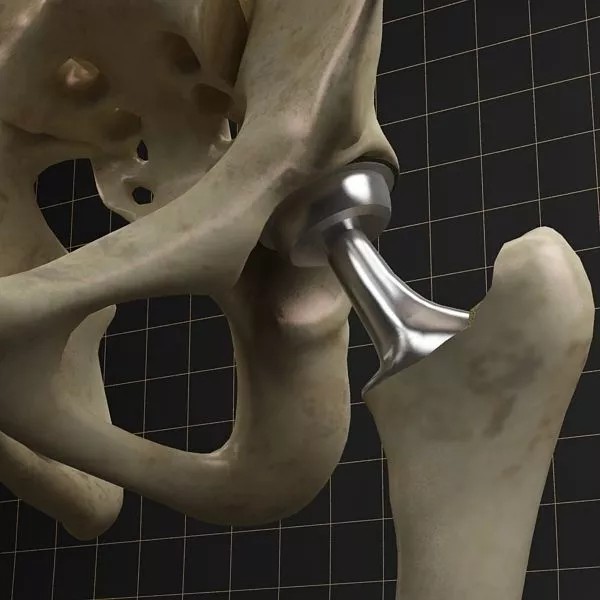 Femoral Prosthesis 3D Model – Complete Skeleton with PBR Textures, FBX