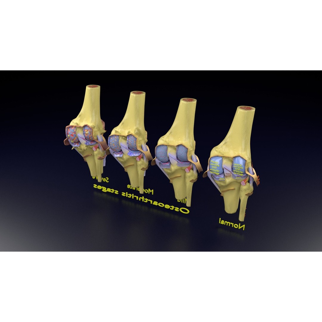 Osteoarthritis 3D Model – Medical Anatomy with Detailed Staging