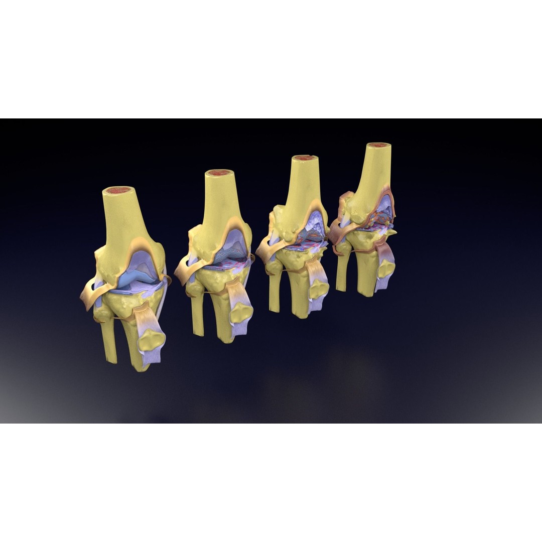 Osteoarthritis 3D Model – Medical Anatomy with Detailed Staging - View 100