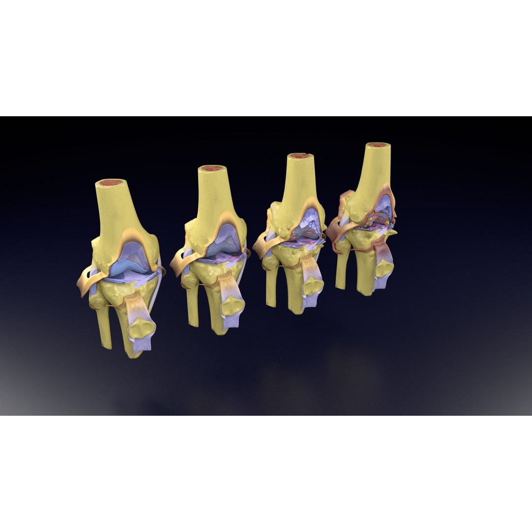 Osteoarthritis 3D Model – Medical Anatomy with Detailed Staging - View 101