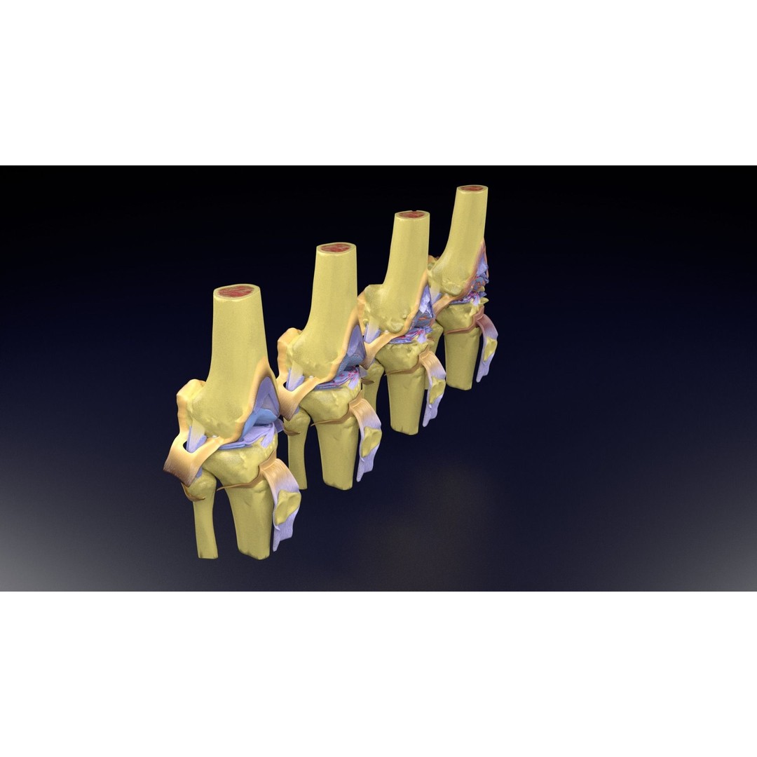 Osteoarthritis 3D Model – Medical Anatomy with Detailed Staging - View 102