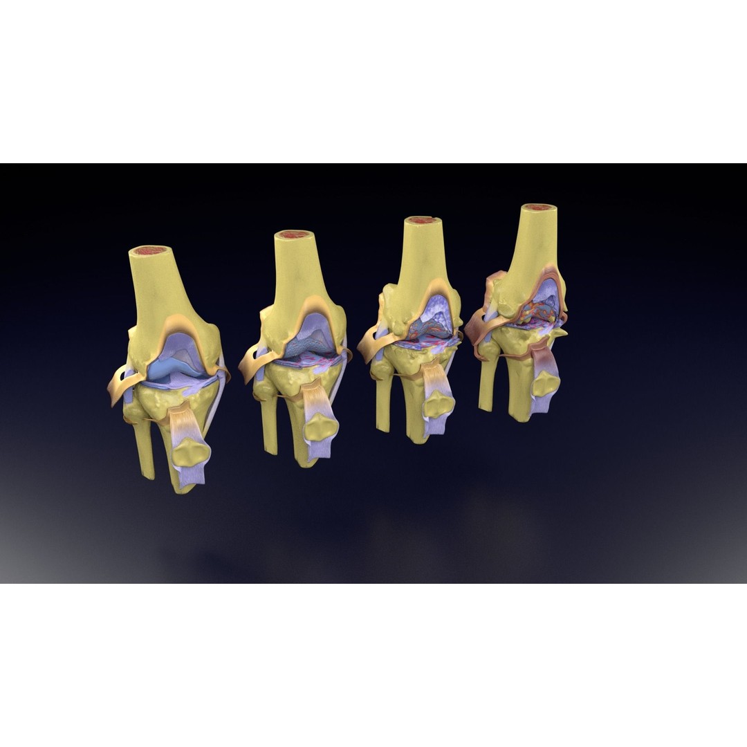 Osteoarthritis 3D Model – Medical Anatomy with Detailed Staging - View 103