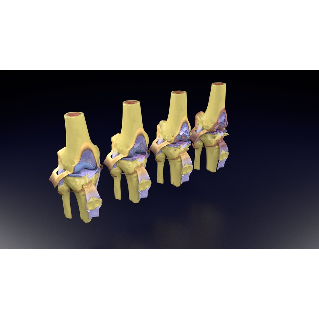 Osteoarthritis 3D Model – Medical Anatomy with Detailed Staging - View 104