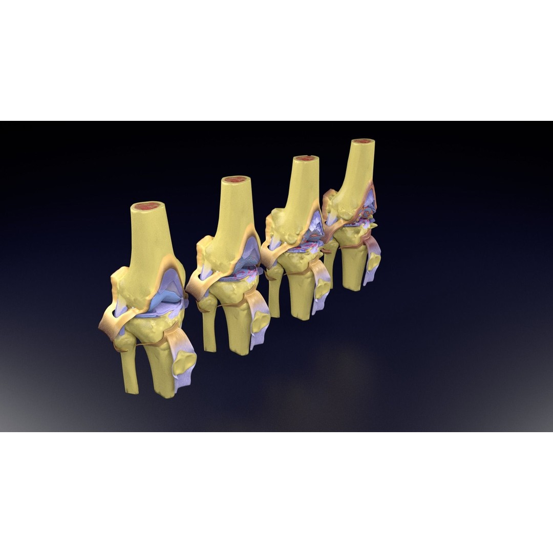 Osteoarthritis 3D Model – Medical Anatomy with Detailed Staging - View 105