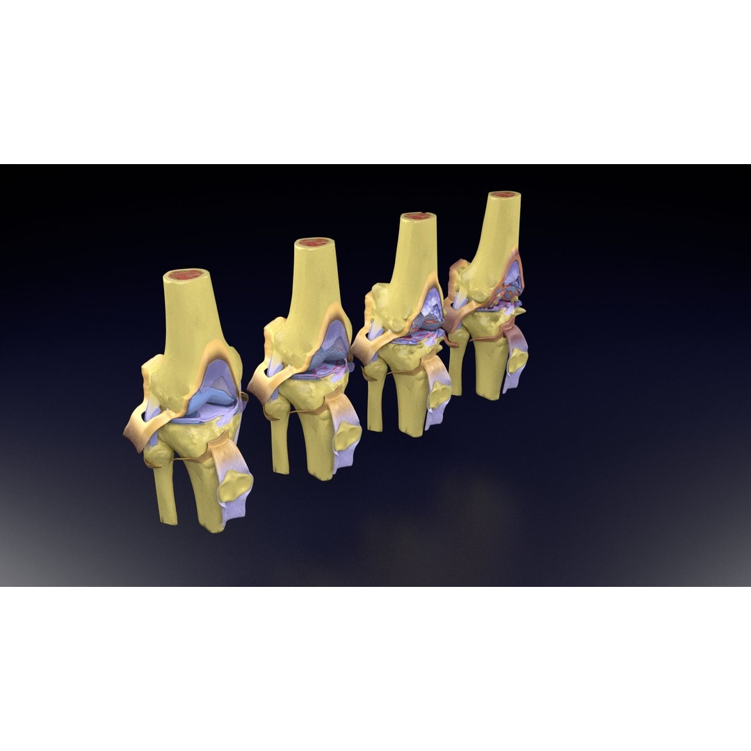 Osteoarthritis 3D Model – Medical Anatomy with Detailed Staging - View 106