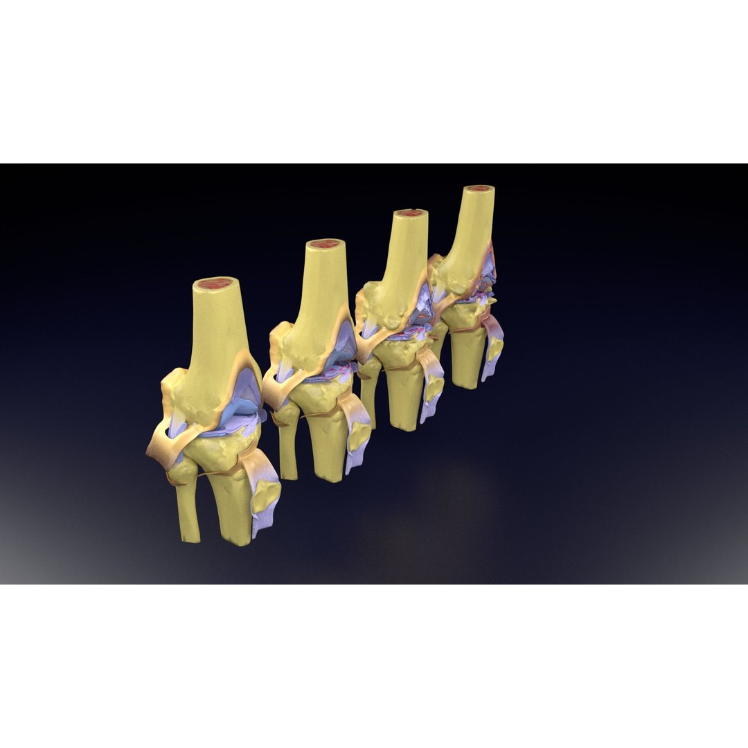 Osteoarthritis 3D Model – Medical Anatomy with Detailed Staging - View 107