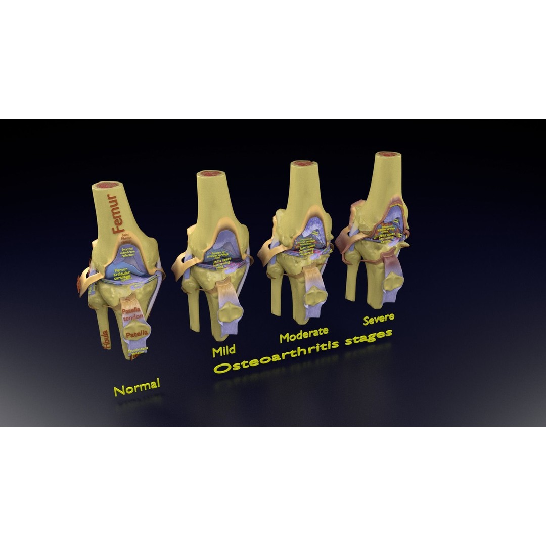 Osteoarthritis 3D Model – Medical Anatomy with Detailed Staging - View 108