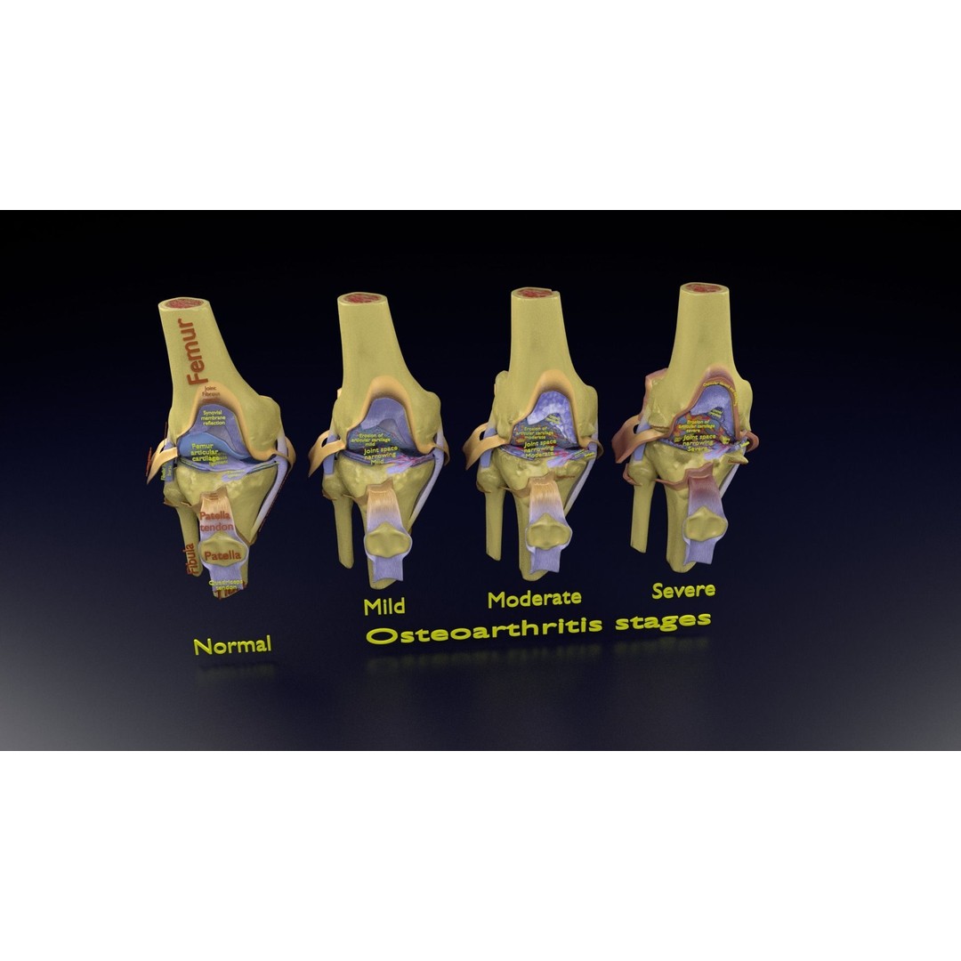 Osteoarthritis 3D Model – Medical Anatomy with Detailed Staging - View 109