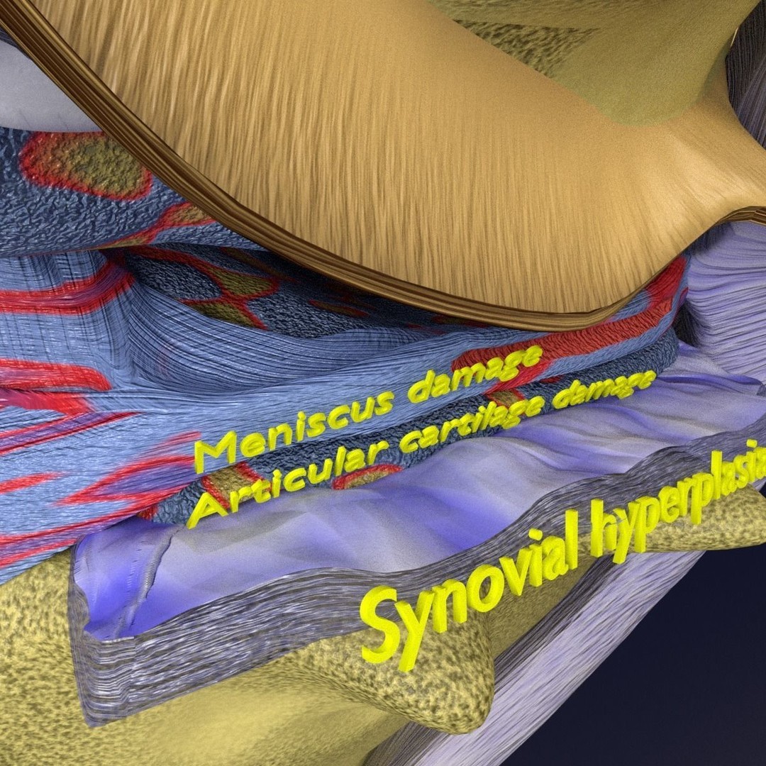 Osteoarthritis 3D Model – Medical Anatomy with Detailed Staging - View 11