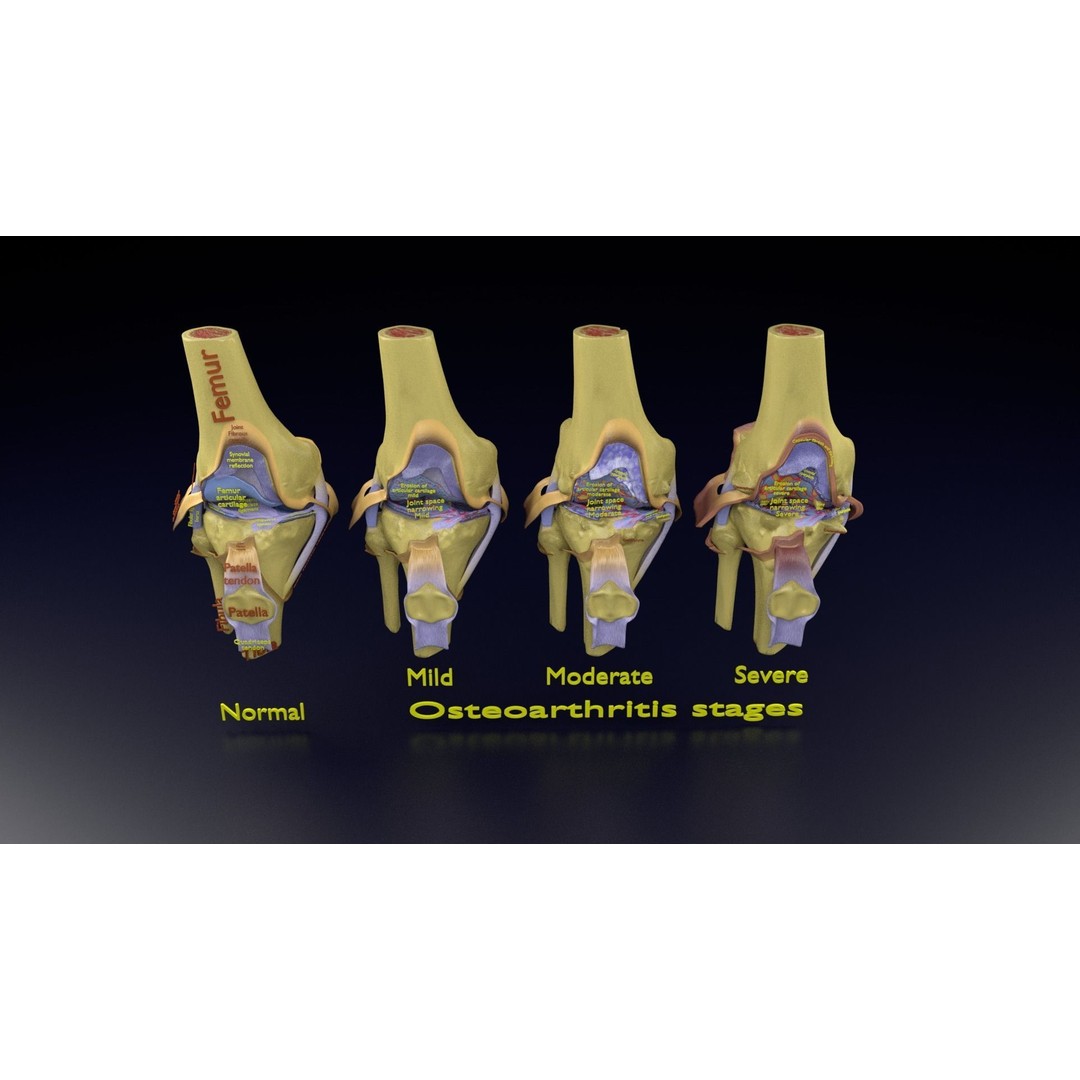 Osteoarthritis 3D Model – Medical Anatomy with Detailed Staging - View 110