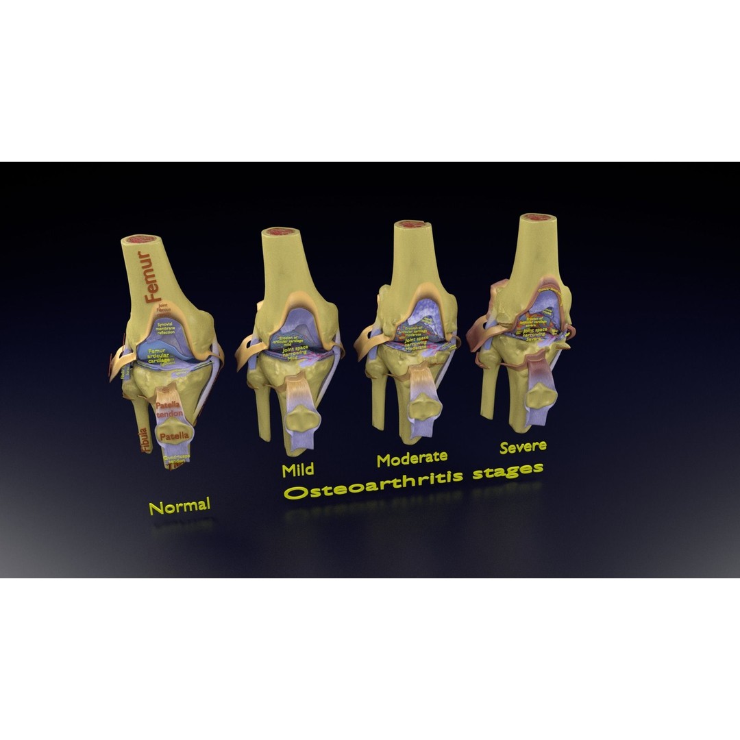 Osteoarthritis 3D Model – Medical Anatomy with Detailed Staging - View 111