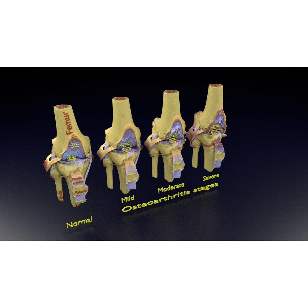 Osteoarthritis 3D Model – Medical Anatomy with Detailed Staging - View 112