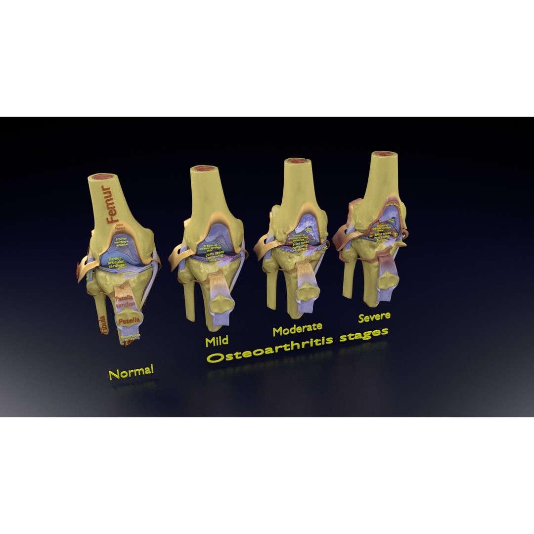 Osteoarthritis 3D Model – Medical Anatomy with Detailed Staging - View 113
