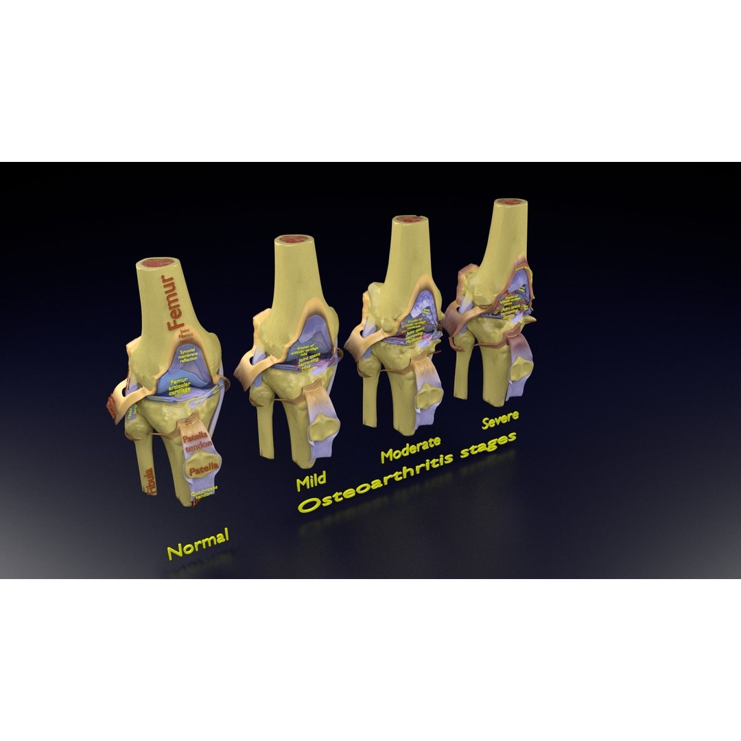 Osteoarthritis 3D Model – Medical Anatomy with Detailed Staging - View 114