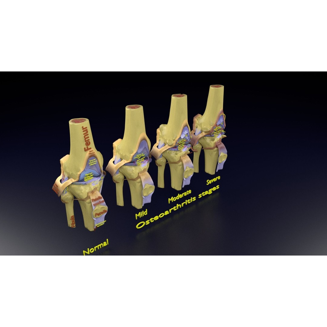 Osteoarthritis 3D Model – Medical Anatomy with Detailed Staging - View 115