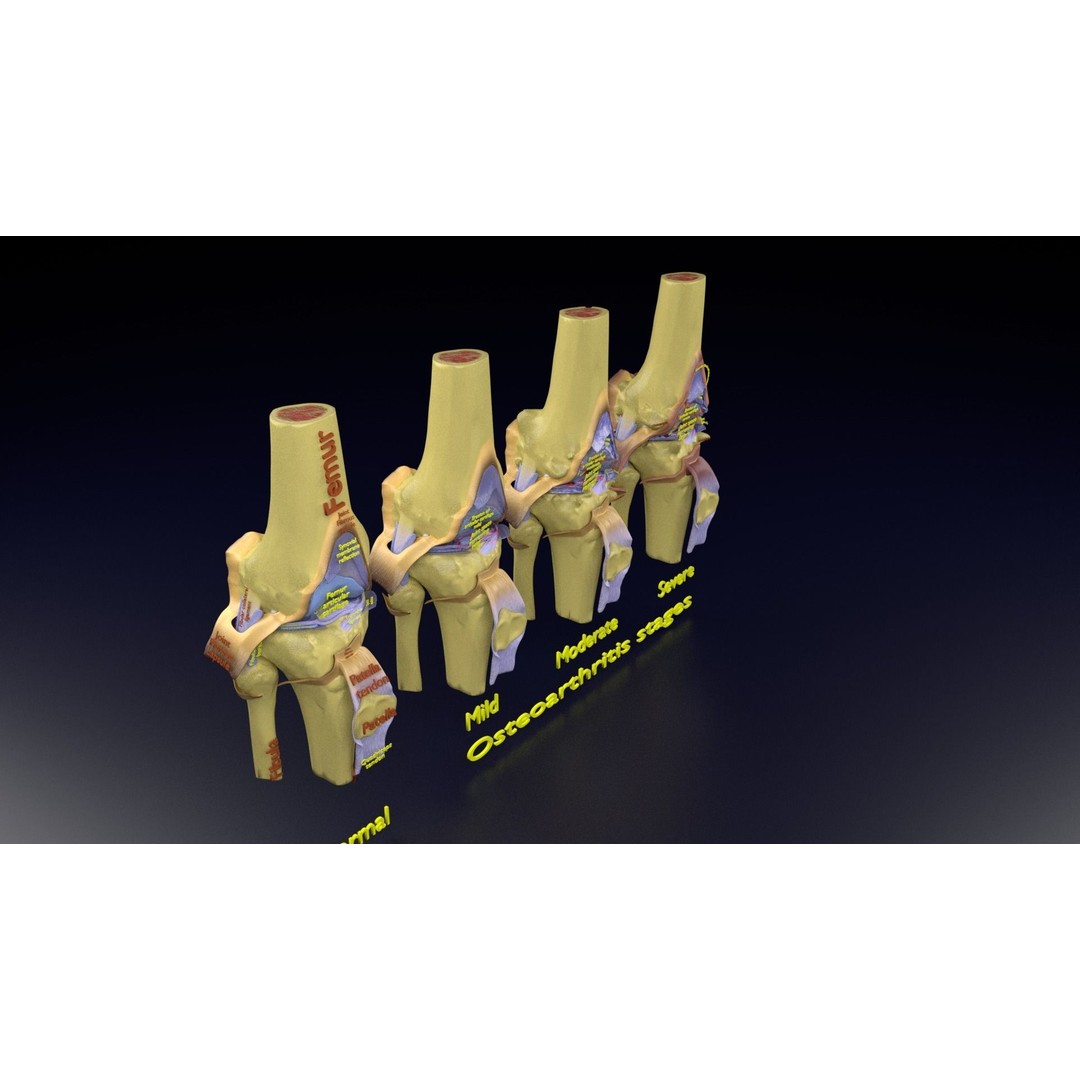 Osteoarthritis 3D Model – Medical Anatomy with Detailed Staging - View 116
