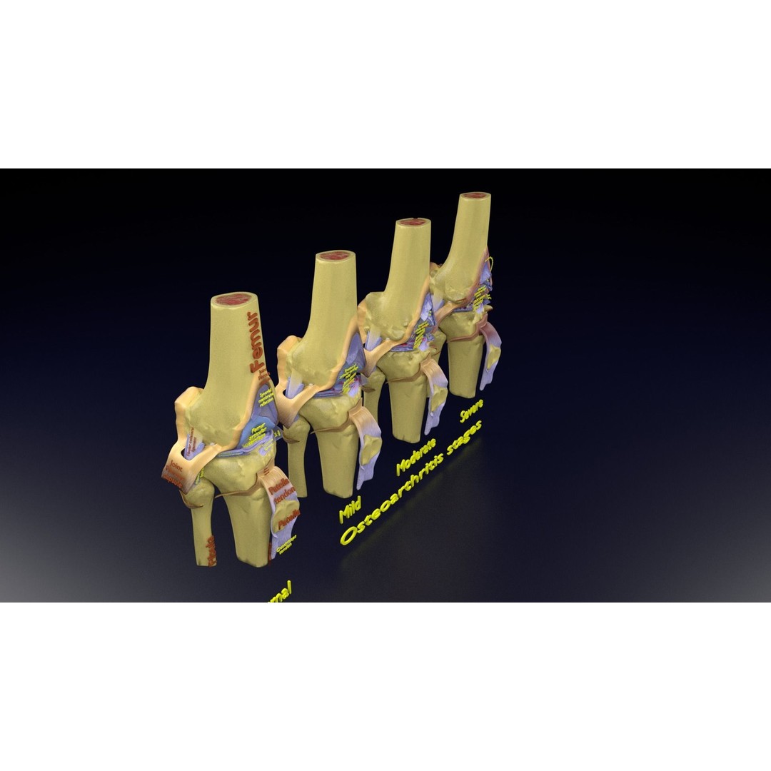 Osteoarthritis 3D Model – Medical Anatomy with Detailed Staging - View 117