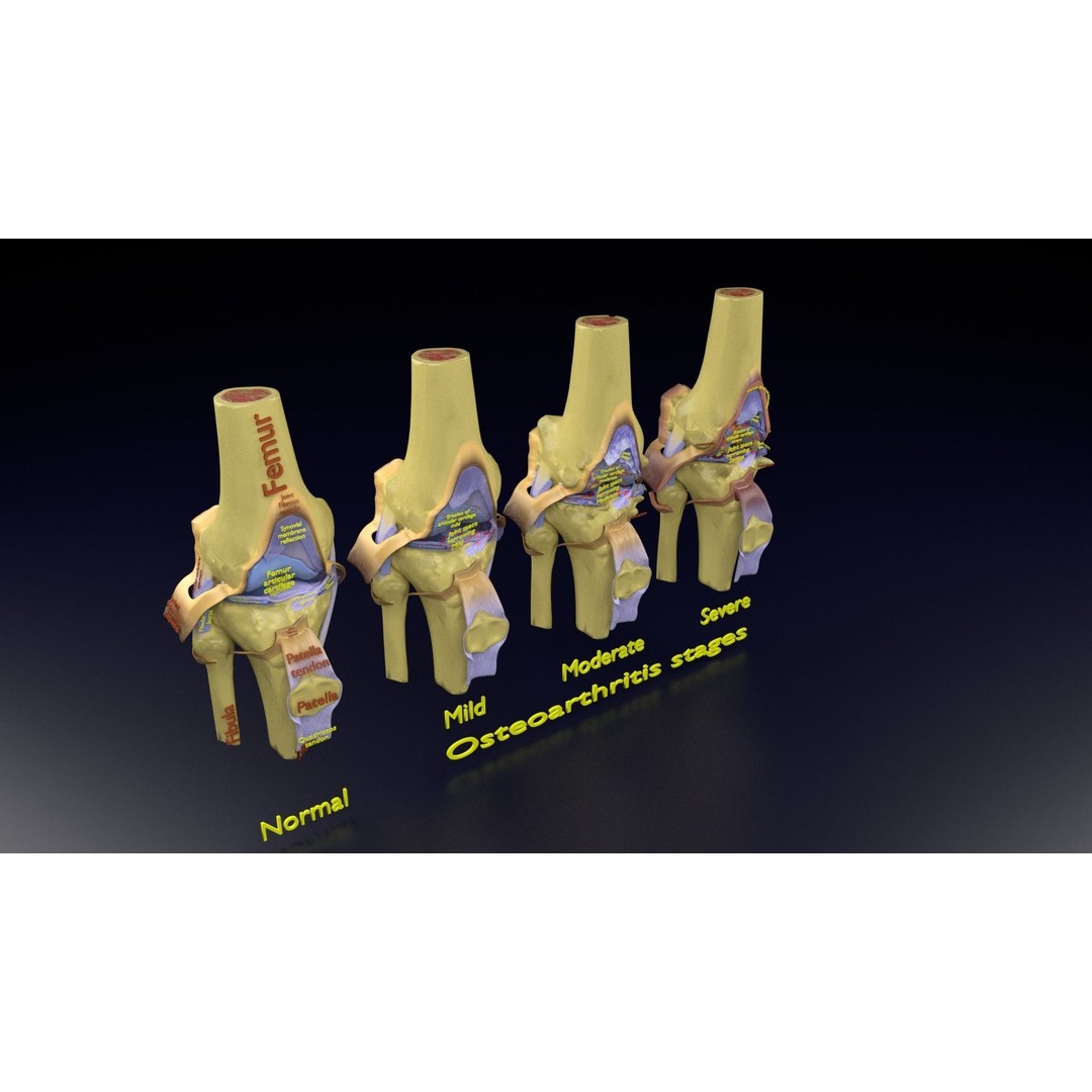 Osteoarthritis 3D Model – Medical Anatomy with Detailed Staging - View 118