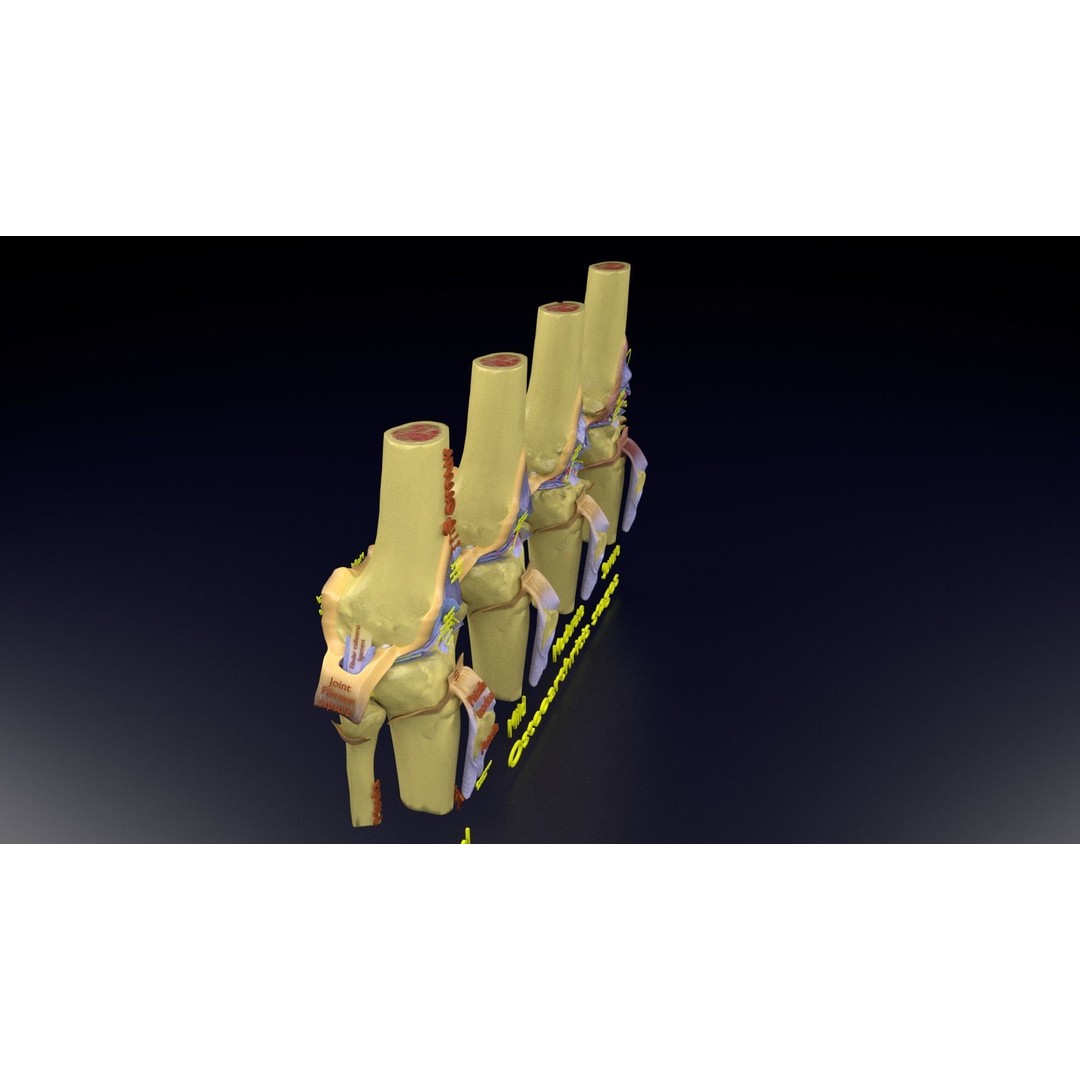 Osteoarthritis 3D Model – Medical Anatomy with Detailed Staging - View 119