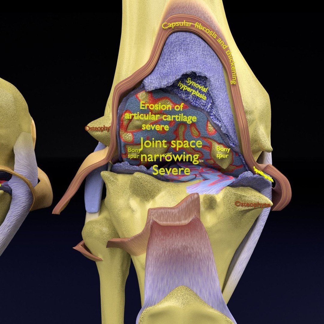 Osteoarthritis 3D Model – Medical Anatomy with Detailed Staging - View 12