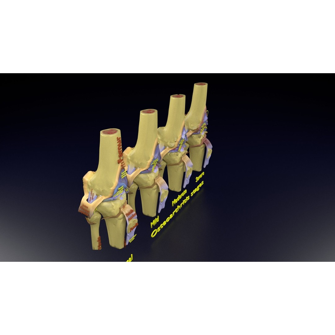 Osteoarthritis 3D Model – Medical Anatomy with Detailed Staging - View 120