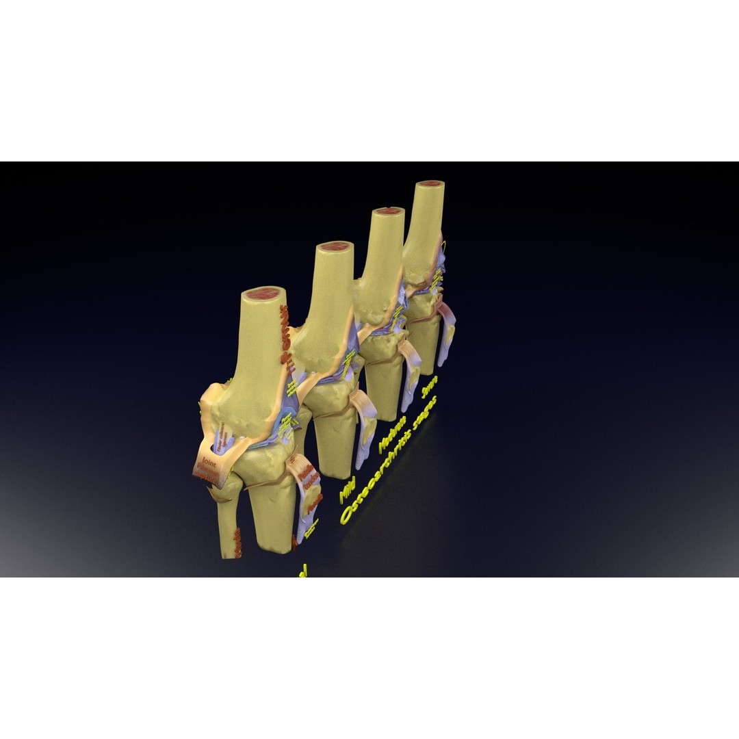Osteoarthritis 3D Model – Medical Anatomy with Detailed Staging - View 121