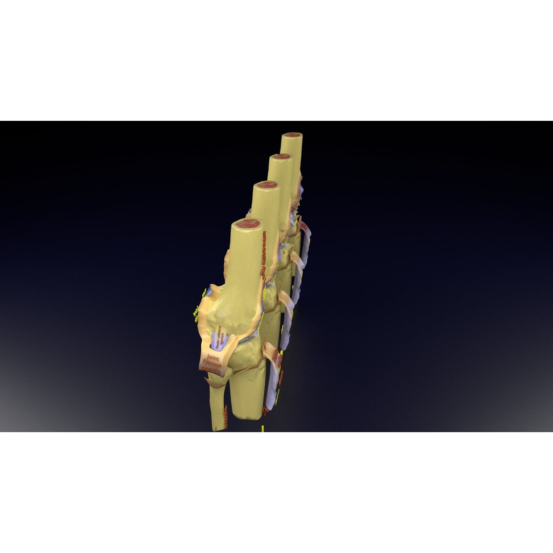 Osteoarthritis 3D Model – Medical Anatomy with Detailed Staging - View 122