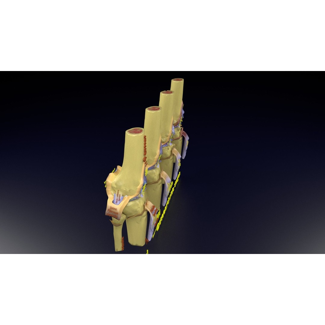 Osteoarthritis 3D Model – Medical Anatomy with Detailed Staging - View 123