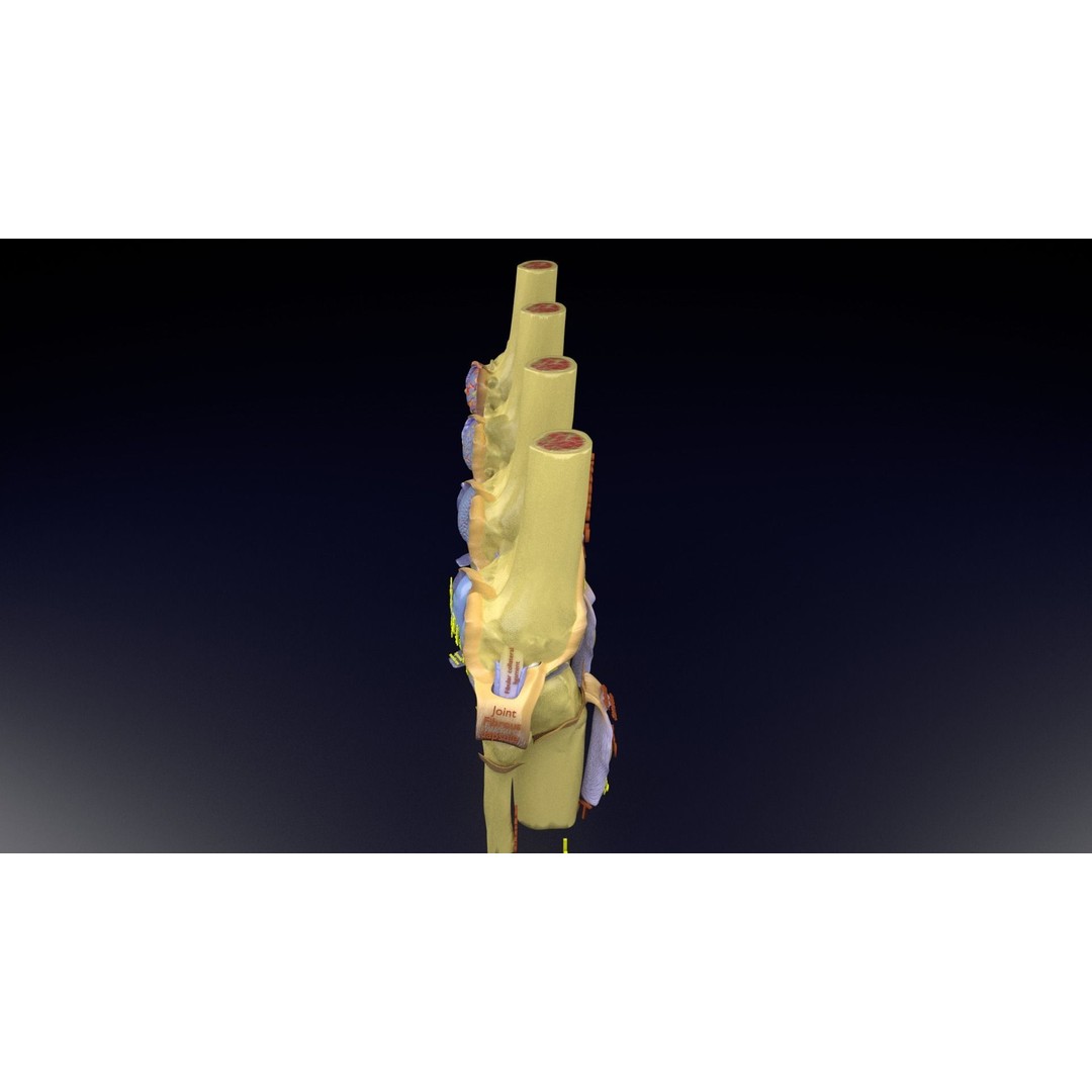 Osteoarthritis 3D Model – Medical Anatomy with Detailed Staging - View 124