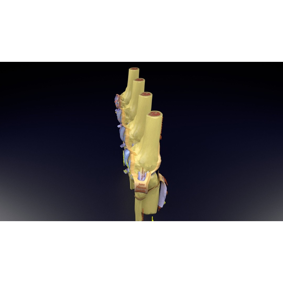 Osteoarthritis 3D Model – Medical Anatomy with Detailed Staging - View 125