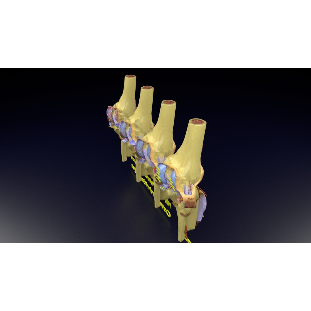 Osteoarthritis 3D Model – Medical Anatomy with Detailed Staging - View 126