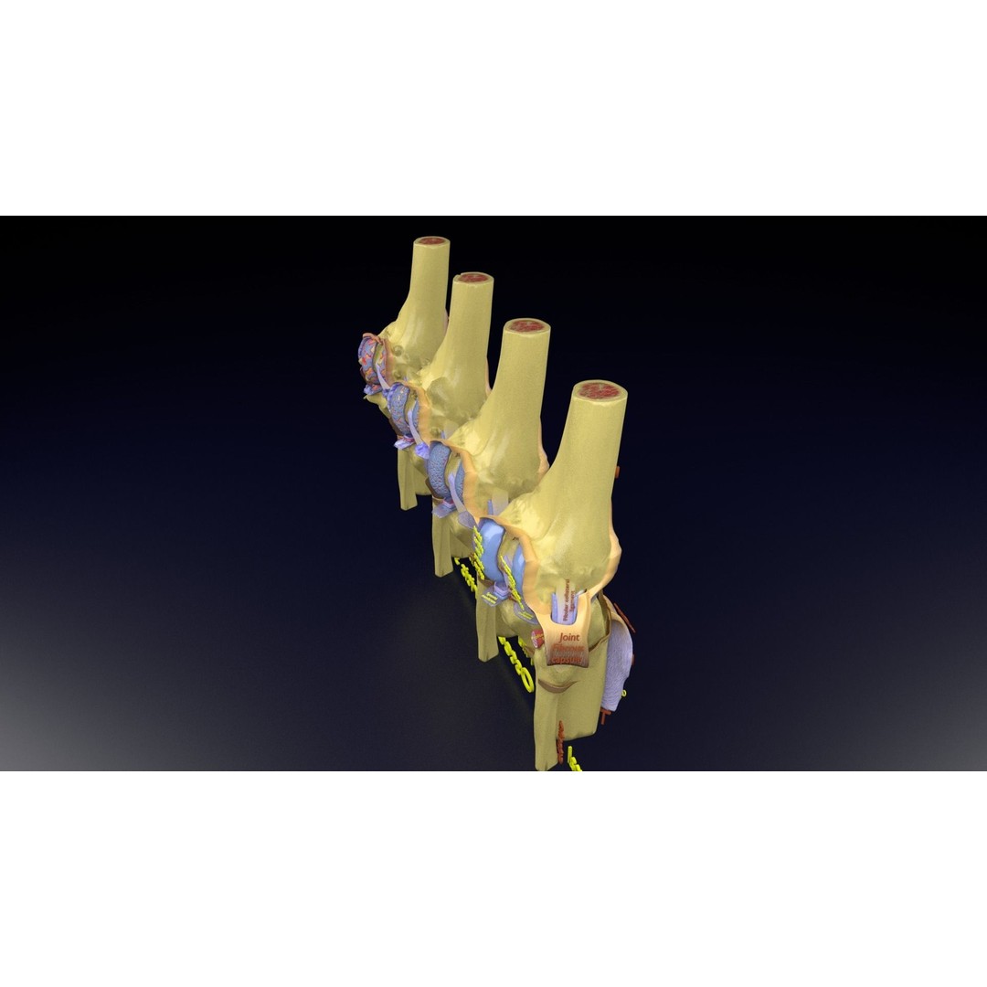 Osteoarthritis 3D Model – Medical Anatomy with Detailed Staging - View 127