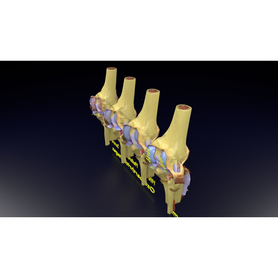 Osteoarthritis 3D Model – Medical Anatomy with Detailed Staging - View 128
