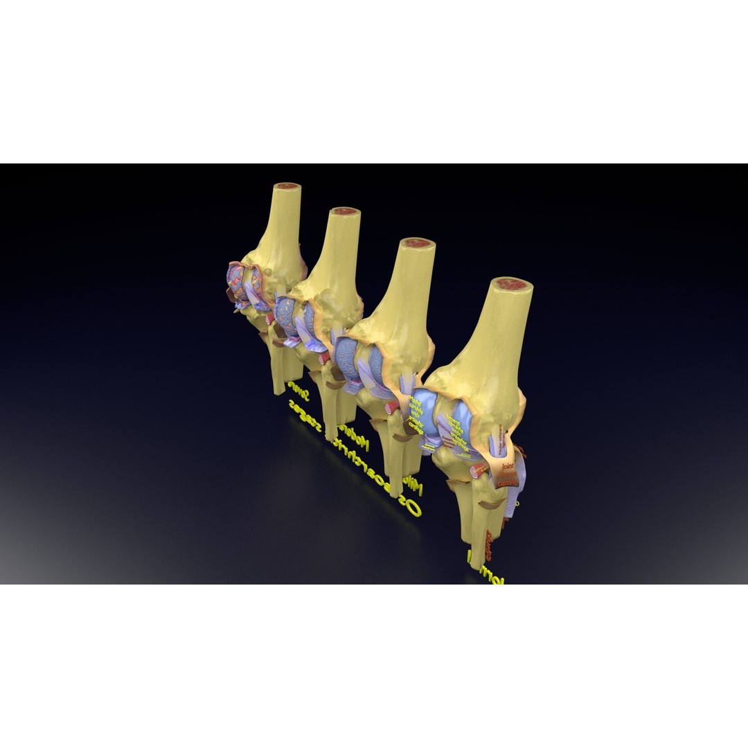 Osteoarthritis 3D Model – Medical Anatomy with Detailed Staging - View 129
