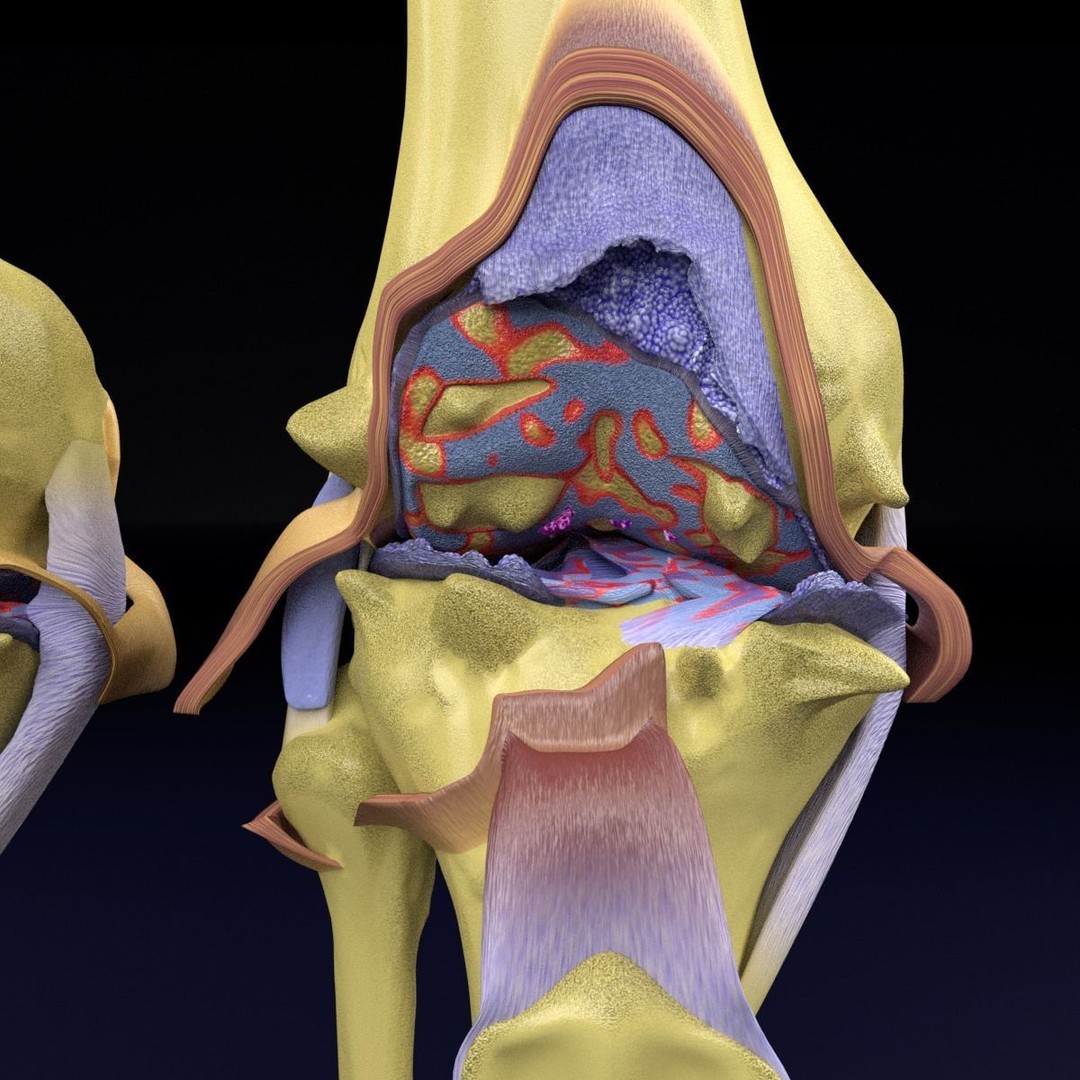 Osteoarthritis 3D Model – Medical Anatomy with Detailed Staging - View 13