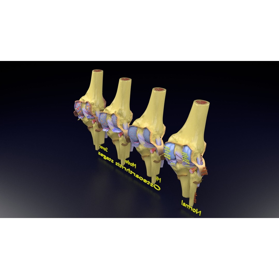 Osteoarthritis 3D Model – Medical Anatomy with Detailed Staging - View 130