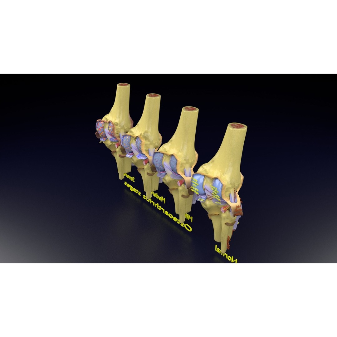 Osteoarthritis 3D Model – Medical Anatomy with Detailed Staging - View 131