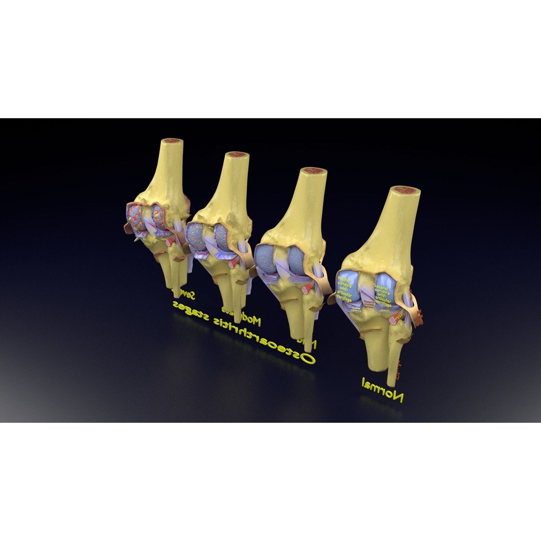 Osteoarthritis 3D Model – Medical Anatomy with Detailed Staging - View 132