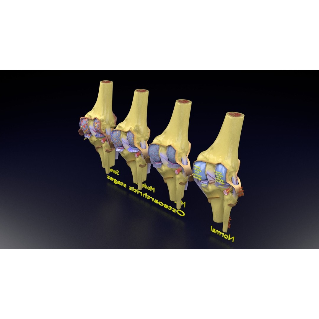 Osteoarthritis 3D Model – Medical Anatomy with Detailed Staging - View 133