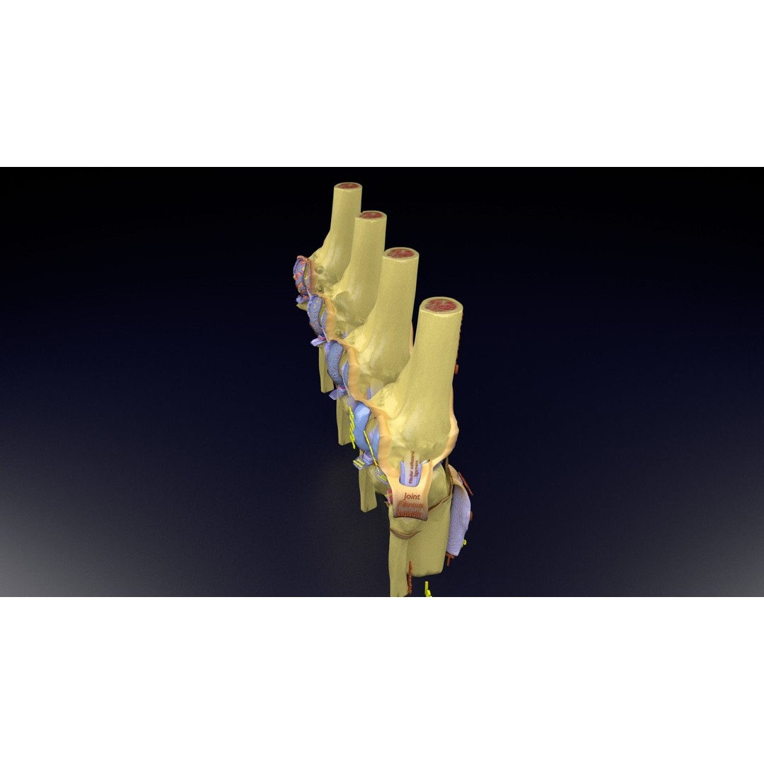 Osteoarthritis 3D Model – Medical Anatomy with Detailed Staging - View 134