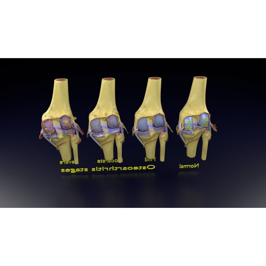 Osteoarthritis 3D Model – Medical Anatomy with Detailed Staging - View 136