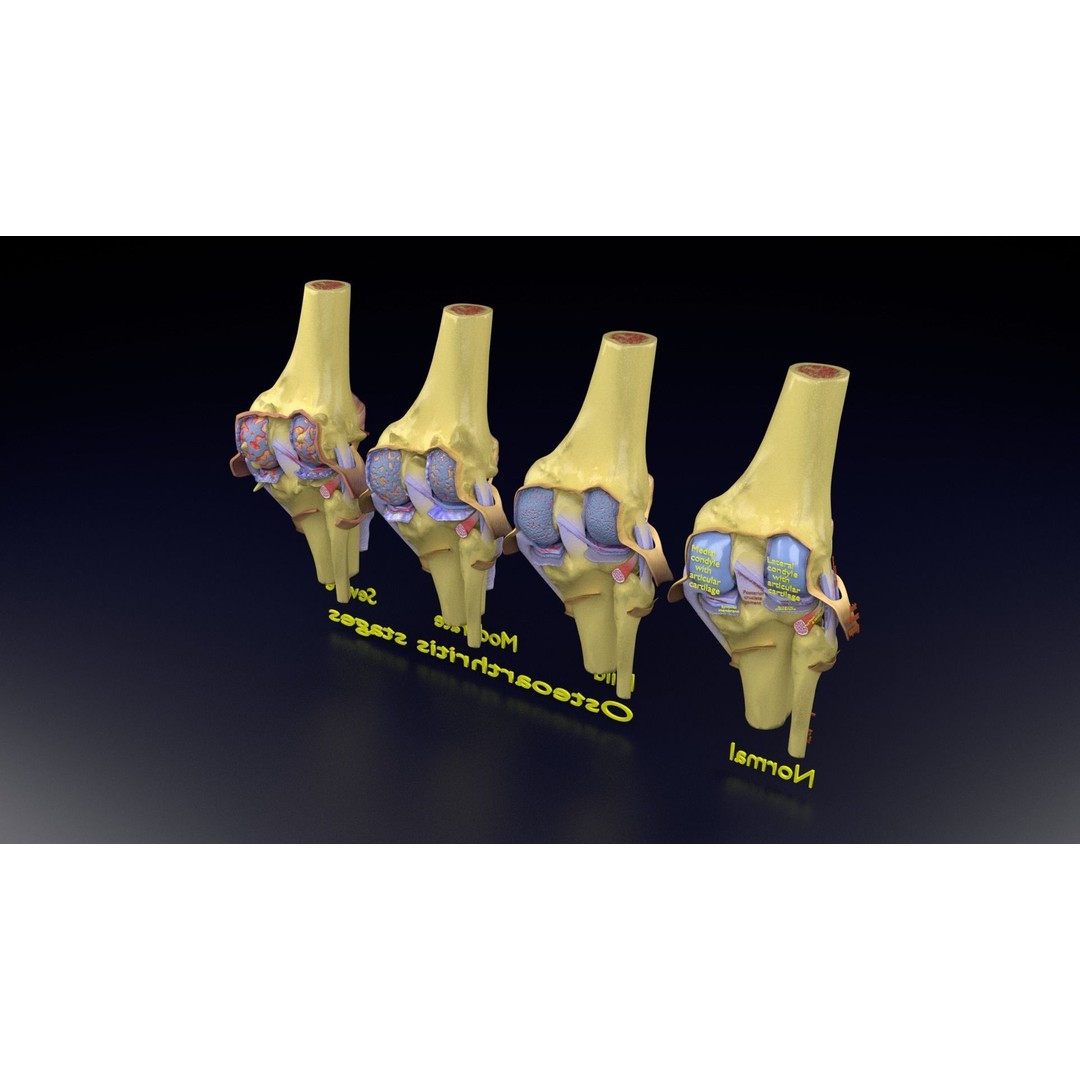 Osteoarthritis 3D Model – Medical Anatomy with Detailed Staging - View 137