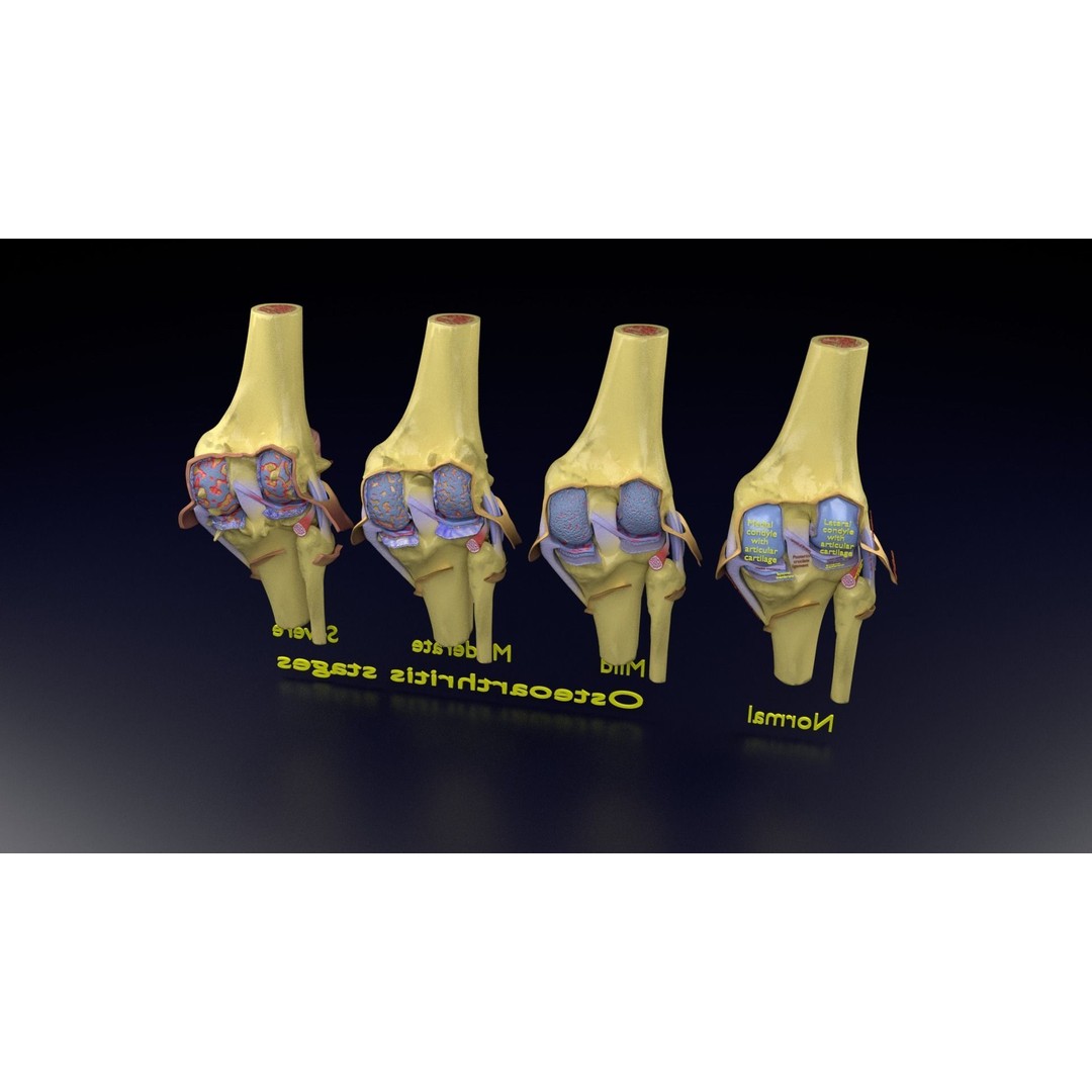 Osteoarthritis 3D Model – Medical Anatomy with Detailed Staging - View 138