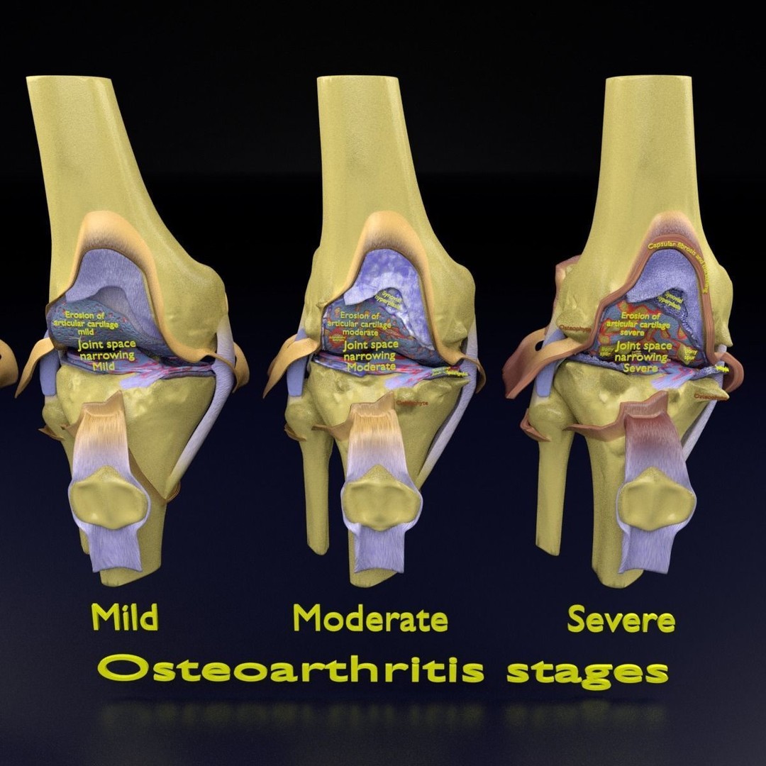 Osteoarthritis 3D Model – Medical Anatomy with Detailed Staging - View 14