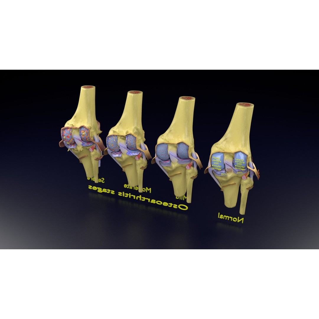 Osteoarthritis 3D Model – Medical Anatomy with Detailed Staging - View 140