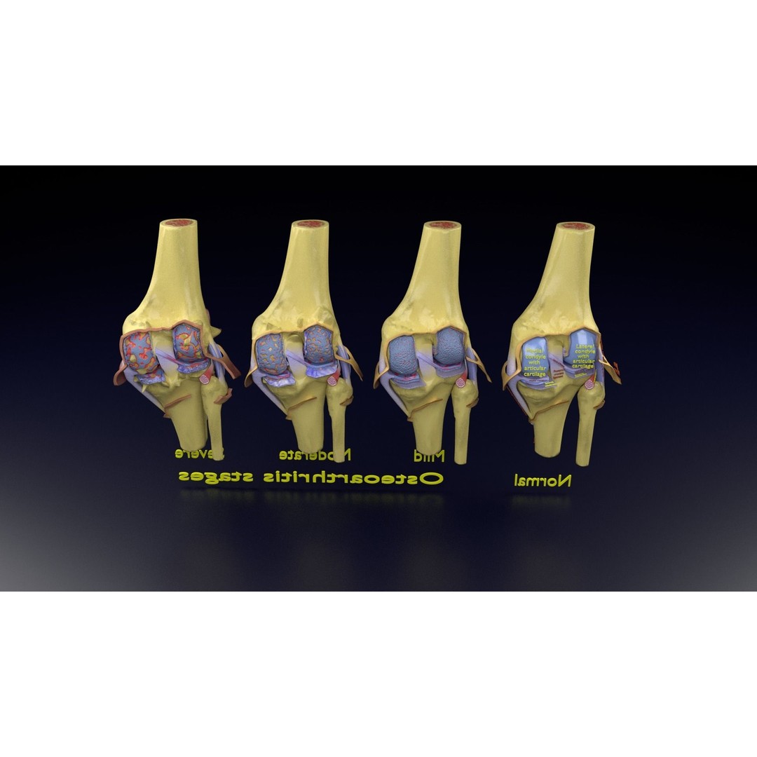Osteoarthritis 3D Model – Medical Anatomy with Detailed Staging - View 141