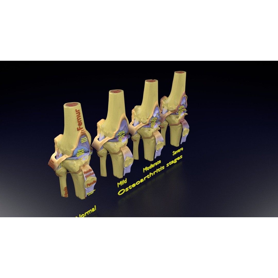 Osteoarthritis 3D Model – Medical Anatomy with Detailed Staging - View 142